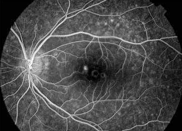 angiografia de ojos